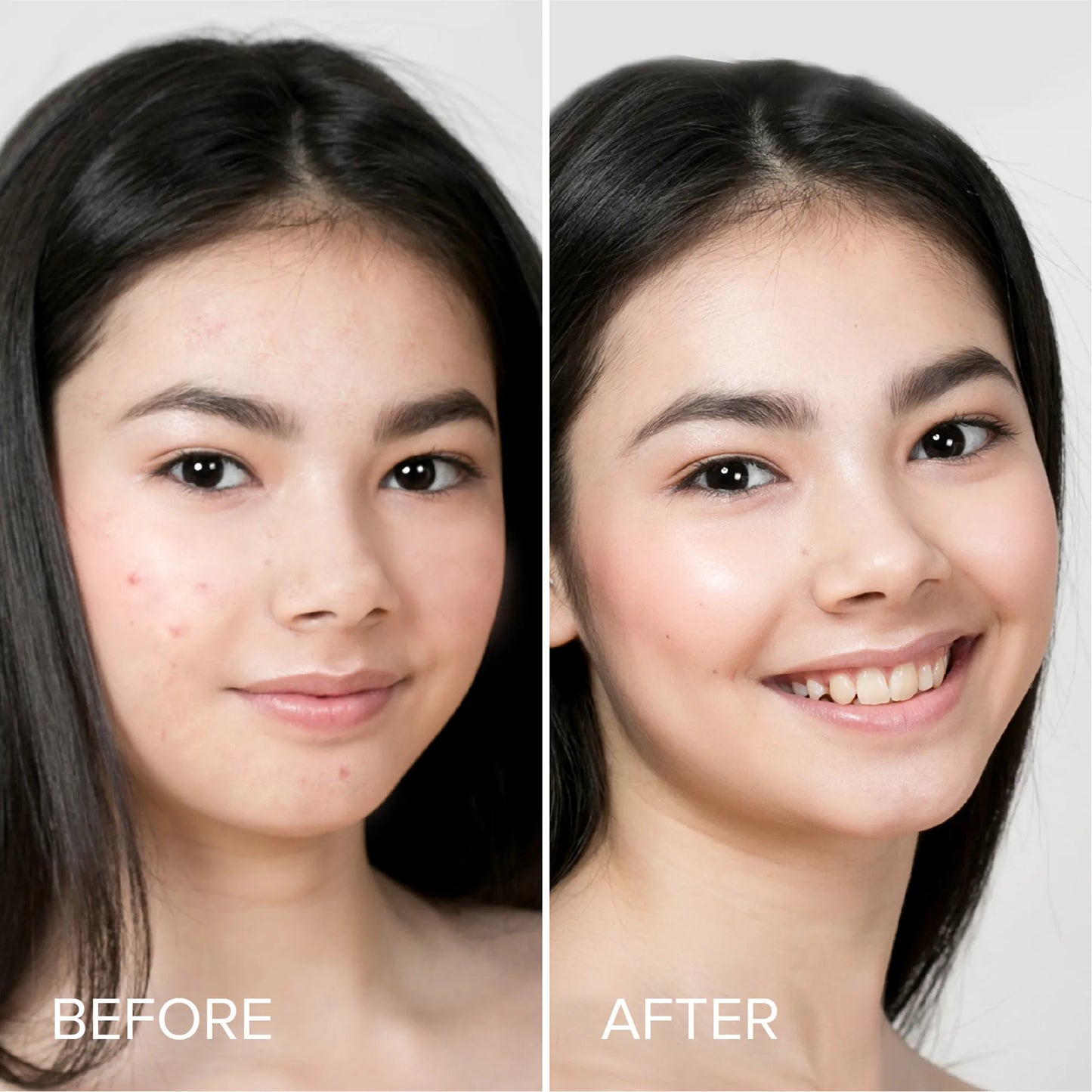 Pimple & Acne Patches – Medical-Grade Hydrocolloid with Tea Tree Oil